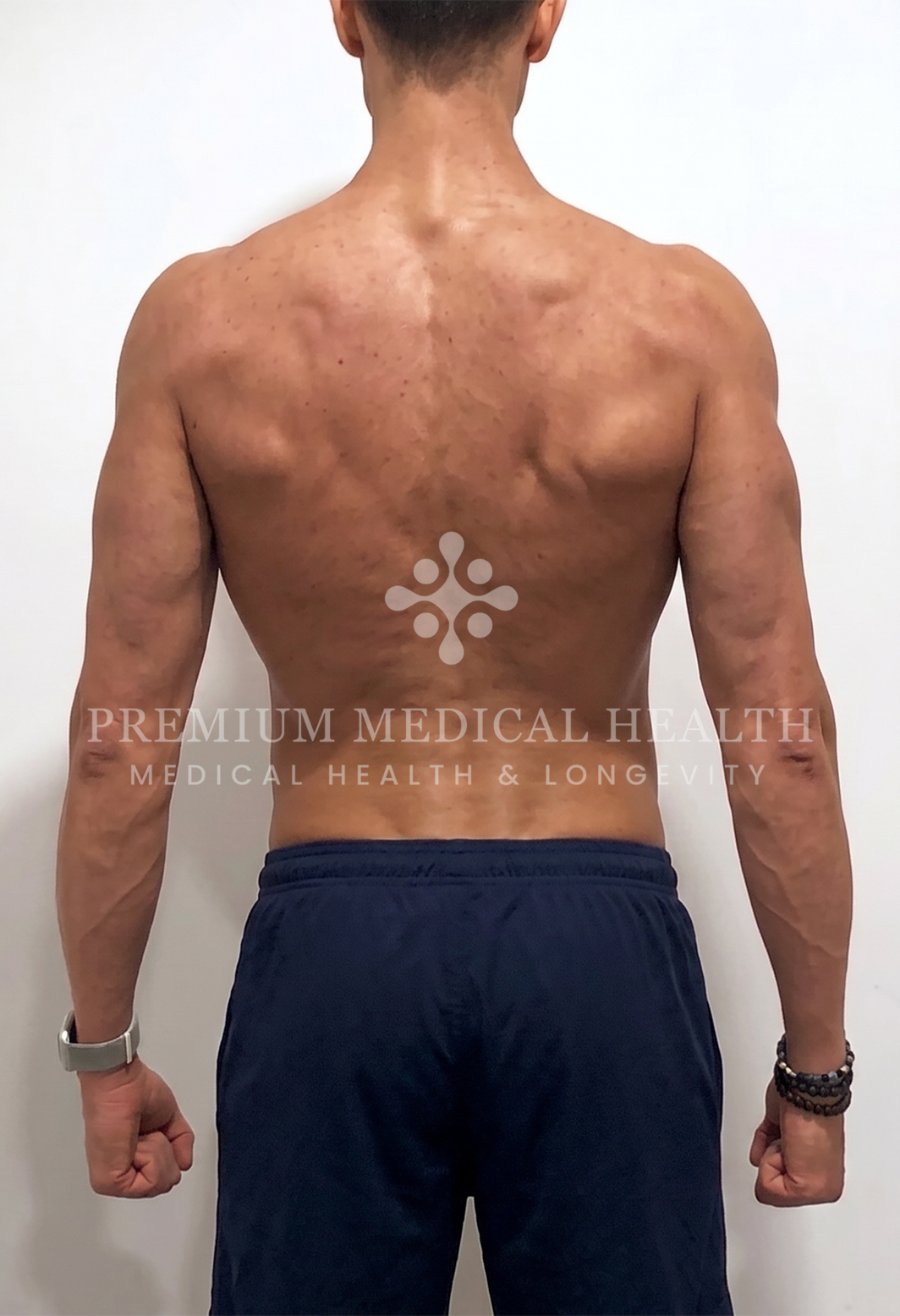 Ahmed, posterior post-protocol